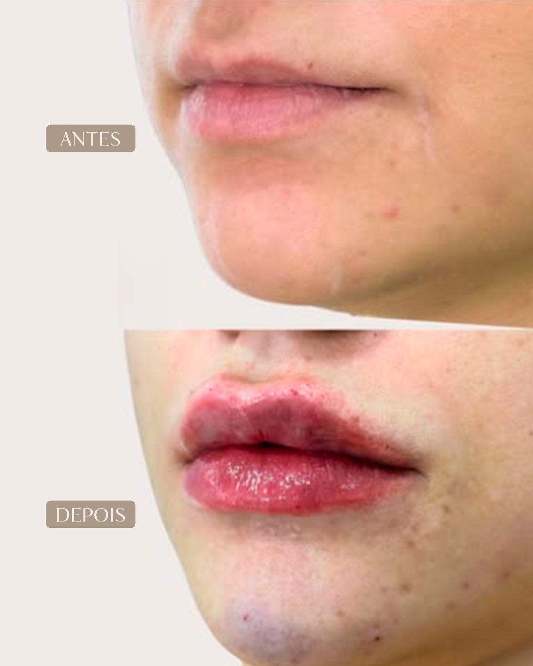 ANTES E DEPOIS 10-