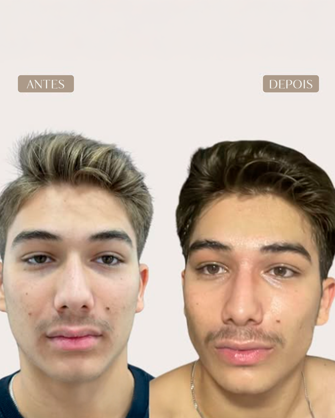 ANTES E DEPOIS 5-