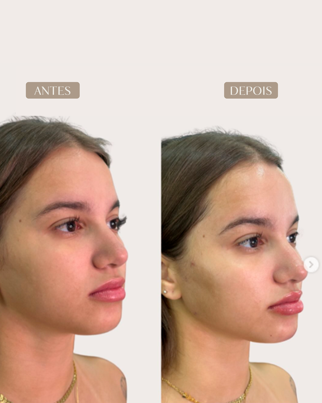ANTES E DEPOIS 7-