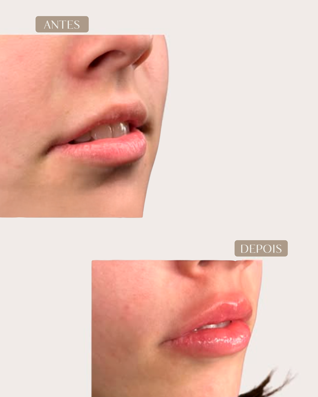 ANTES E DEPOIS 9-