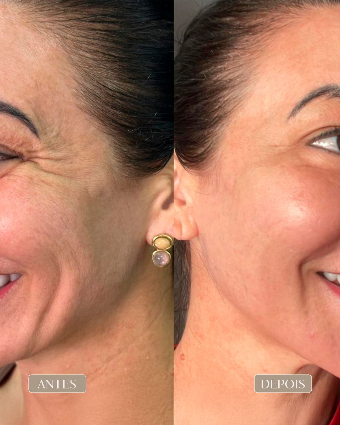 ANTES E DEPOIS 11-