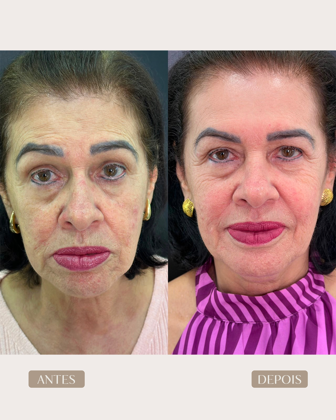 ANTES E DEPOIS 15-2